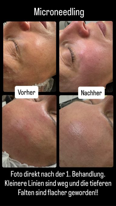 Microneedling